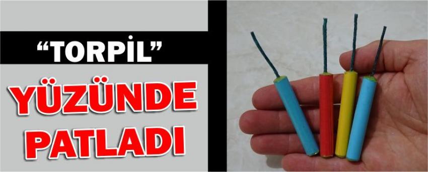 “Torpil” Yüzünde Patladı