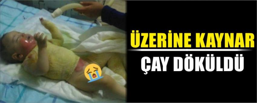 Üzerine Kaynar Çay Döküldü